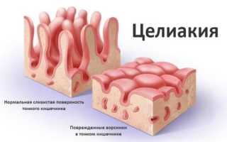Целиакия: симптомы у взрослых, диагностика и лечение