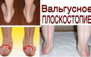 Как лечить вальгусное плоскостопие у взрослых и детей