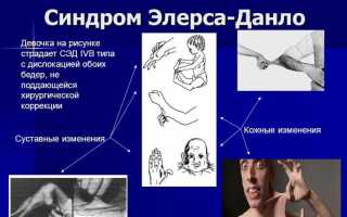 Как лечить синдром Элерса-Данлоса: советы и рекомендации