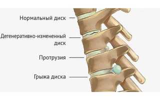 Что такое дискогенная радикулопатия и её причины