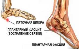 Как лечить пяточную шпору в домашних условиях