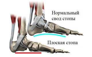 Как лечить продольное плоскостопие у взрослых и детей