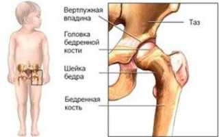 Как лечить врожденный вывих бедра у детей