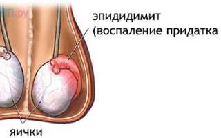 Воспаление придатка семенника (эпидидимит): причины, признаки, методы терапии