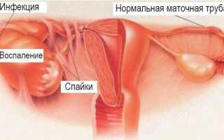 Симптомы и лечение хронического аднексита у женщин
