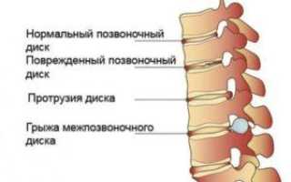 Как восстановить межпозвоночные хрящи для здоровья позвоночника