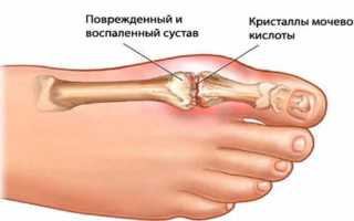 Как лечить отложение солей в стопе эффективно и безопасно