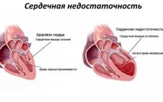 Хроническая сердечная недостаточность: классификация, симптомы и лечение