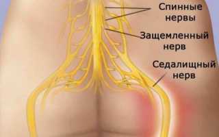 Как вылечить седалищный нерв народными средствами в домашних условиях