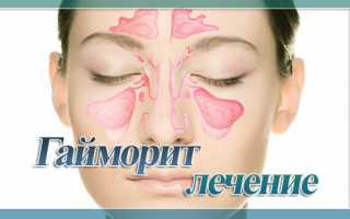 Как лечить гайморит: 10 проверенных способов для лечения дома и у специалиста