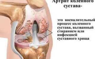 Как лечить артрит коленного сустава эффективно и безопасно