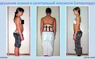 Как лечить лордоз поясничного отдела эффективно и безопасно