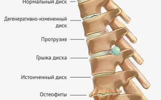 Что такое дорсопатия позвоночника и её причины