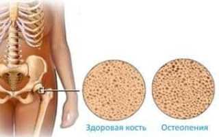 Что такое остеопения и её последствия для здоровья