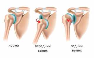 Как лечить растяжение связок плечевого сустава: советы и рекомендации