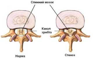 Как лечить стеноз позвоночного канала шейного отдела правильно и эффективно