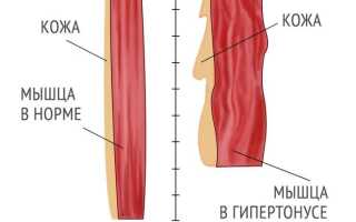 Как лечить гипертонус мышц у детей и взрослых