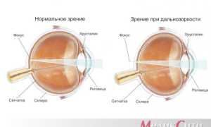 Что такое гиперметропия высокой степени (3 степень)