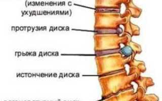 Как лечить спондилез шейного отдела позвоночника: советы и рекомендации