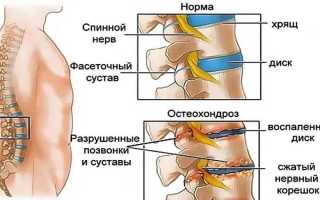 Как лечат остеохондроз поясничного отдела: методы и рекомендации