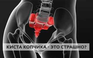 Как лечить воспаление копчикового хода эффективно и безопасно