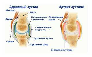 Как лечить артрит ног эффективно и безопасно