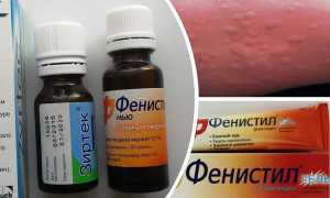 Крапивница: как выглядит у взрослых, причины и лечение аллергии