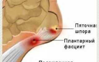 Чем мазать шпору на пятке для облегчения боли