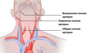 Левосторонний инсульт головного мозга – симптомы, последствия, прогноз