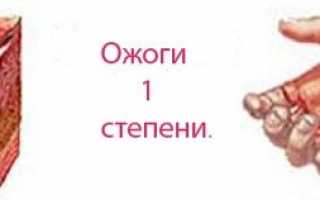 Первая помощь при ожогах: виды ожогов и что делать при ожоге