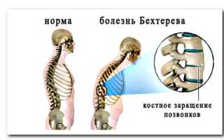 Что делать, болит спина в положении лежа, советы и рекомендации