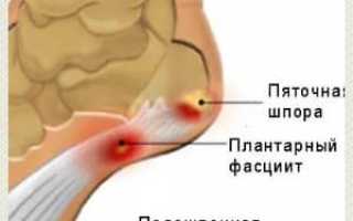 Лечебная гимнастика при пяточной шпоре для эффективного восстановления