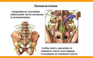 Что такое ламинэктомия позвоночника и её особенности