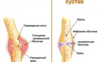 Какие препараты применяются для лечения ревматизма и их эффективность