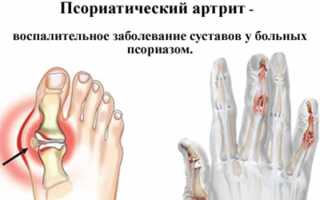 Какие бывают артриты и их особенности