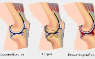 Что такое недифференцированный артрит и его особенности