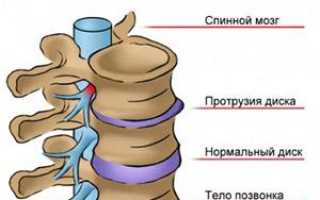Может ли повышаться температура при остеохондрозе и что с этим делать