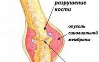Как лечить ревматизм ног эффективно и безопасно