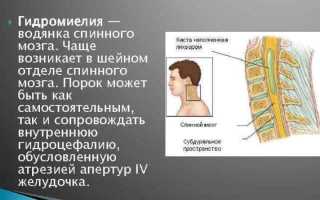 Что такое гидромиелия и как её лечить: полезная информация и советы