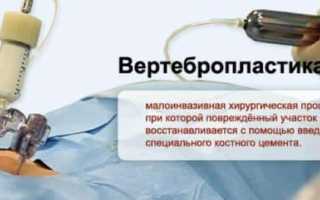 Что такое вертебропластика позвоночника и её преимущества