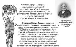 Как лечить синдром Броун-Секара: советы и рекомендации