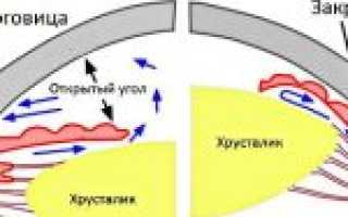Открытоугольная глаукома 1 и 2 степени: причины, симптомы, лечение и профилактика