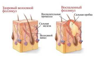 Лечение фурункула (фурункулеза) в домашних условиях