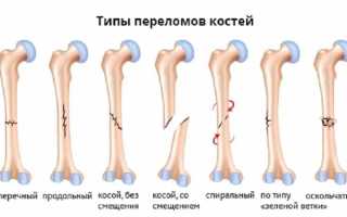 Как лечить перелом ноги правильно и эффективно