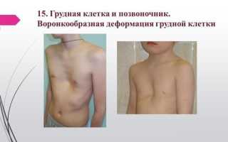 Какие бывают деформации грудной клетки и их причины