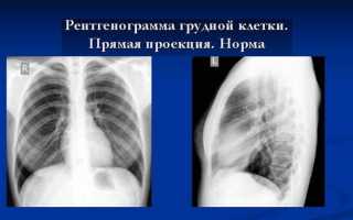 Что показывает рентген грудной клетки и его значение