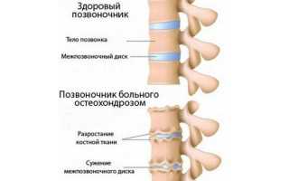 Симптомы и особенности лечения остеохондроза в зависимости от его степени: полезные рекомендации