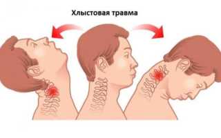 Как лечить хлыстовую травму шеи правильно и эффективно