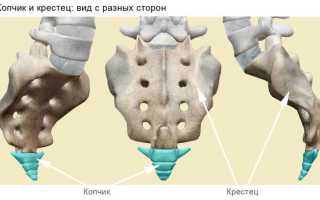 Как лечить перелом крестца правильно и эффективно