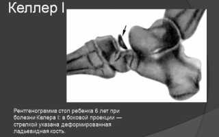 Что такое болезнь Келлера и как её лечить: основные аспекты и рекомендации